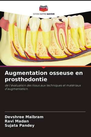 Augmentation osseuse en prosthodontie de Devshree Maibram