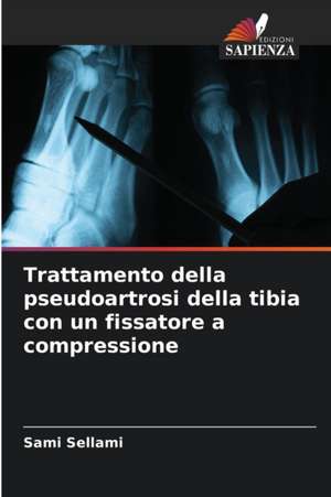 Trattamento della pseudoartrosi della tibia con un fissatore a compressione de Sami Sellami