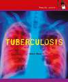 Tuberculosis