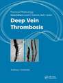 Practical Phlebology: Deep Vein Thrombosis