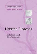 Uterine Fibroids: Embolization and other Treatments