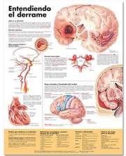 Understanding Stroke Anatomical Chart in Spanish (Entendiendo qué es un derrame)