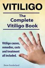 Vitiligo. Vitiligo Causes, Remedies, Costs and Treatment All Included. the Complete Vitiligo Book.