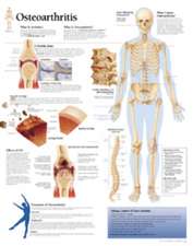 Understanding Osteoarthritis Chart: Wall Chart