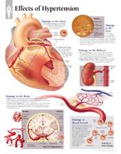 Effects of Hypertension Chart: Wall Chart