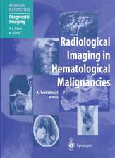 Radiological Imaging in Hematological Malignancies