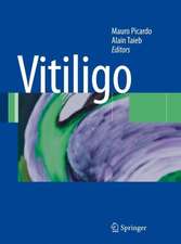 Vitiligo