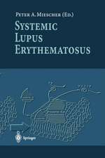 Systemic Lupus Erythematosus