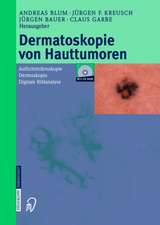 Dermatoskopie Von Hauttumoren